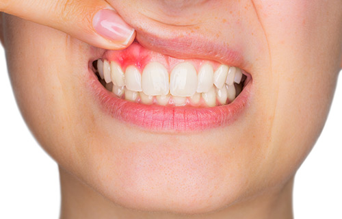 Clínica boutique Dental Madrid – periodoncia - tratamientos son para mantener sana tu encía y el hueso que rodea tus dientes