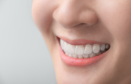 Clínica boutique Dental Madrid – ortodoncia - Con este tratamiento podemos moverte los dientes de forma sencilla y conservadora para mejorar tu mordida y tu estética.